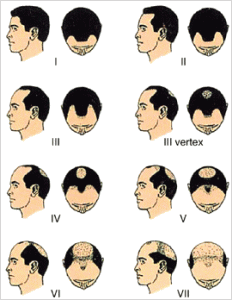 norwood-1 Norwood Scale of Male Pattern Baldness